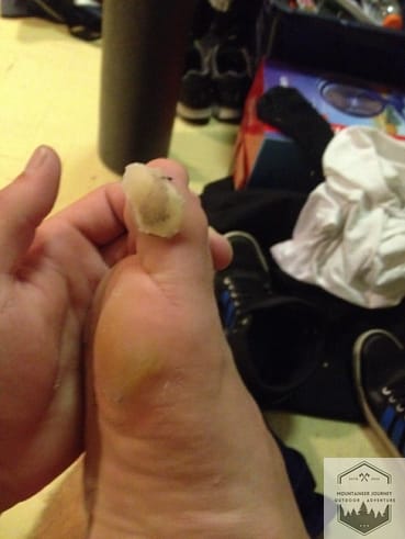 blog-img-1732996894376 example of a decompressed blister